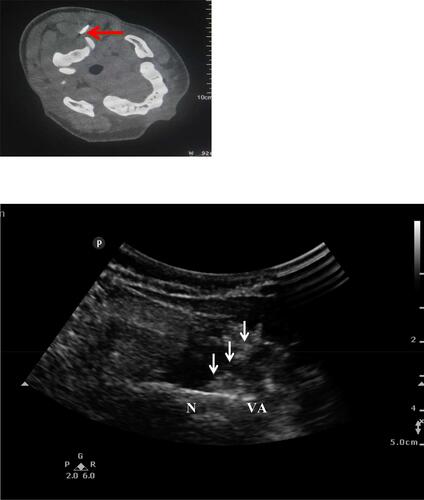 Figure 3 Needle was placed under US-guidance and confirmed by CT-slice. Red arrow: C2 in the CT scan. White arrow: puncture needle in the US fig. Reproduced from Li J, Yin Y, Ye L, Zuo Y. Pulsed radiofrequency of C2 dorsal root ganglion under ultrasound guidance for chronic migraine: a case report. Journal of Pain Research. 2018;11:1915–1919. Copyright © 2018 Li et al.Citation10Abbreviations: VA, vertebral artery; N, C2 nerve root and dorsal root ganglion.