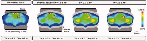 Figure 14. Simulated temperature distributions when applying 10 °C overlay boluses at various salinities, compared with the default situation without overlay boluses. The optimal treatment set-up for this patient was considered, i.e., prone position and two 25 cm diameter electrodes. Total power was scaled such that the maximum predicted normal tissue temperature did not exceed 45 °C.