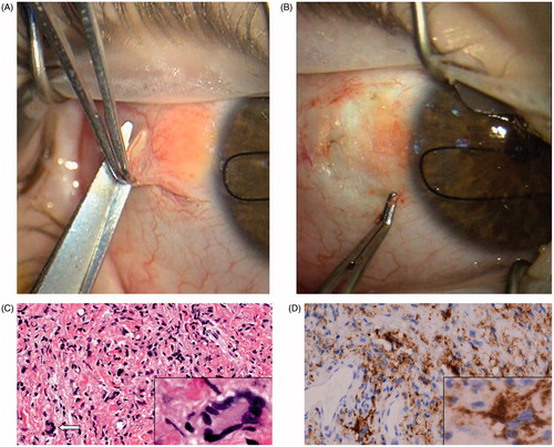 Figure 1. (A) Surgical excision of a subconjunctival yellow-orange lesion at the bulbar conjunctiva. (B) The subconjunctival mass has been dissected. The infiltration of the sclera was seen during the operation. (C) Microscopically, the specimen showed confluent histiocytes that were not particularly filled with lipid, scattered Touton giant cells (arrow and inset), and lymphocytes (hematoxylin–eosin, original magnification, ×100; inset, original magnification, ×400). (D) Diffuse CD68 positivity (macrophage marker) of the lesion (original magnification, ×100; inset magnification, ×400).