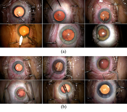 Figure 2 Samples in the anterior capsulotomy classification dataset. (a) The non-Capsulotomy images and (b) the Capsulotomy images.