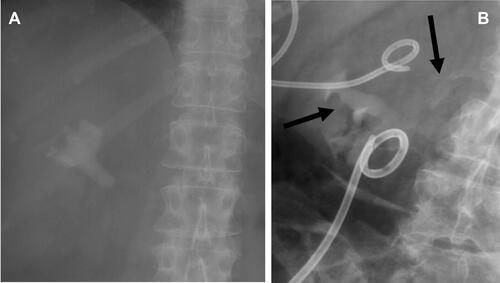 Figure 1 (A) Large staghorn calculus occupying the right renal pelvis with extension into the calyces in a case of confirmed XGP. (B) IVP in a different patient showing absent excretion in the affected upper pole and normal excretion in the unaffected lower pole (more horizontal arrow). A large irregular calculus is also evident immediately caudal to the right transverse process of L3 (more vertical arrow). The larger drain further caudally is in a psoas abscess and was inserted from the groin.