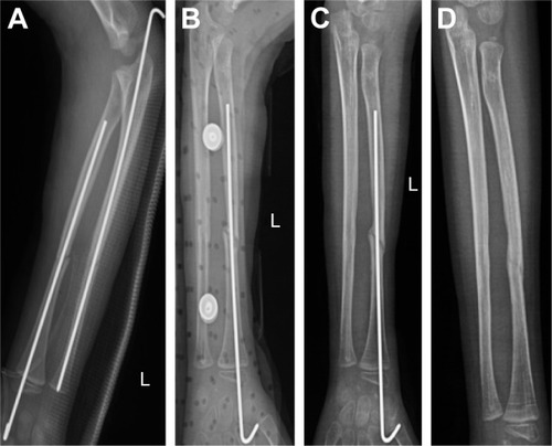 Figure 3 X-ray images of ulnoradial diaphyses fracture treated by internal fixation and PABMT. A 6-year-old boy suffered from ulnoradial diaphyses fracture following a fall and was treated with K-wire fixation (A). Three months after the operation, the ulnar fracture was healed clinically, but the fracture line in the radial shaft was clear without close endings (a sign of nonunion) (B). The K-wire in the ulna was pulled out, and the K-wire in the radius was left to continue to fix. Four weeks later, there was no progress in fracture healing – only a small amount of callus occurred and the fracture line was clear – the PABMT was carried out (C). At the sixth week after PABMT operation, the fracture line was fuzzy (D), the internal fixator was removed, and the patient underwent bone healing.