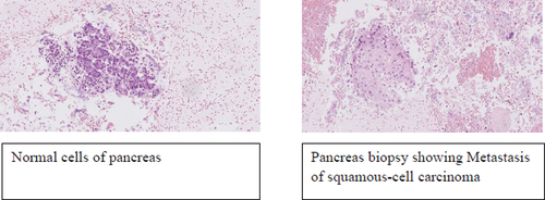 Figure 4. Pathology result from the suspected lesion in the pancreas show squamous-cell carcinoma, metastasis from previous lung cancer.