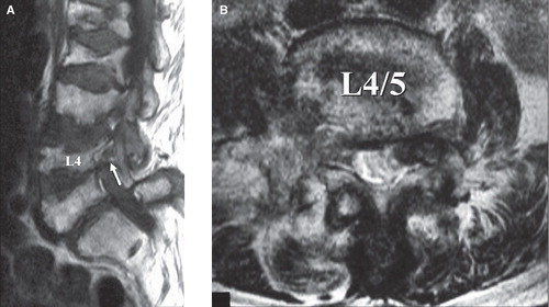 Figure 2. Magnetic resonance imaging (MRI). A: In the sagittal section (right L4/5 foramen; T1-weighted image), foraminal stenosis is not obvious (arrow). B: In the transverse section (L4/5 foramen; T2-weighted image) as well, foraminal stenosis is not evident.