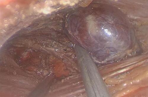 Figure 10 Recurrent laryngeal nerve and parathyroid gland carefully re-checked before rinsing and hemostasis.