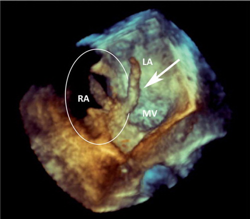 Figure 4. Transesophageal 3-dimensional echocardiographic view through the roof of the left-(LA) and right atrium (RA) looking down on the mitral valve (MV) and the thrombus (arrow).