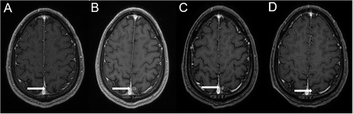 Figure 6 Brain MRI images before and after treatment. The time of MRI was (A) 2022-06-24, (B) 2022-10-24, (C) 2023-02-09, (D) 2023-05-11. (white arrow indicate brain mass in the left parietal lobe).