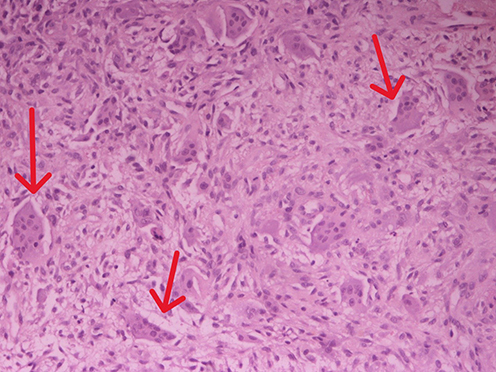 Figure 2 Biopsy from one of the osteolytic rib lesions shows bland fibroblastic spindle cell proliferation admixed with numerous osteoclastic giant cells(arrows), findings which in context are most suggestive of bone changes due to hyperparathyroidism (hematoxylin-eosin, x200).