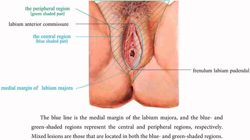 Figure 1. Vulvar division in HIFU treatment.
