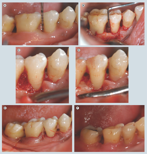 Figure 2.  (A) An example in the experimental group: the second right mandibular premolar, baseline. (B) Intra-surgical findings. (C) Mixture of CGFs and BPBM granules was placed into the defect. (D) CGFs membrane was placed. (E) Flap sutured. (F) 1 year post-surgery.