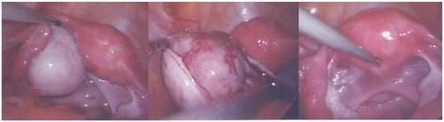 Figure 1 Laparoendoscopic single-site surgery (LESS) for adnexal preservation (intraoperative view).