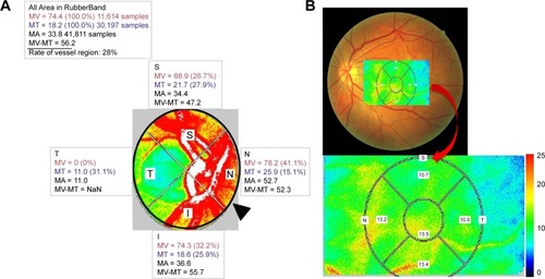 Figure 1 The mean blur rate (MBR) displayed as a 2D color-coded map. (A) MBR at the disc as the retinal blood flow, which was calculated automatically after circling the margin of the optic disc with a rubber band (▲). Since the MBR in the vessel area (MV) includes the MBR in the tissue area (MT), the MBR (MV-MT) was used as the retinal blood flow. (B) MBR at the macula which calculated automatically after configured isometric areas compared MBR maps with fundus photographs was used as the choroidal blood flow.