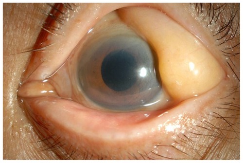 Figure 2 Preoperative anterior segment of the left eye. No lens is present.