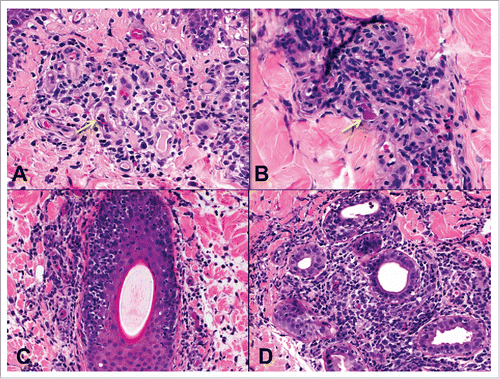 Figure 9. Other pathologic features in rejection. A) Intracapillary mononuclear cells and neutrophils (arrow) in superficial dermal capillaries and a B) capillary thrombus (arrow) in high grade rejection. Mononuclear cell infiltrates along C) a hair follicle and D) sweat glands.