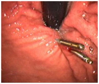 Figure 4 Aspect of the subcardial region after application of the endoclips.