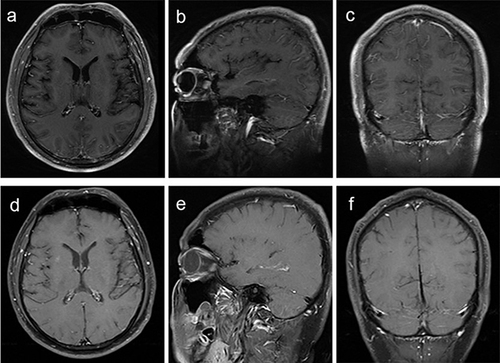 Figure 5 Brain magnetic resonance imaging of patient 3. Brain magnetic resonance imaging showed leptomeningeal enhancement (a–c) 5 days after clinical onset. 2 months after antibiotic treatment, the leptomeningeal enhancement was significantly alleviated (d–f).