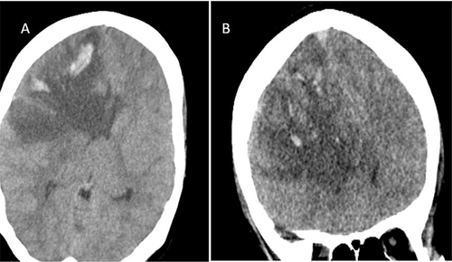 Figure 1 (A and B) Non-contrast cranial CT showed multiple hyperdense venous hemorrhages in the right frontal lobe with surrounding extensive hypodense vasogenic edema.