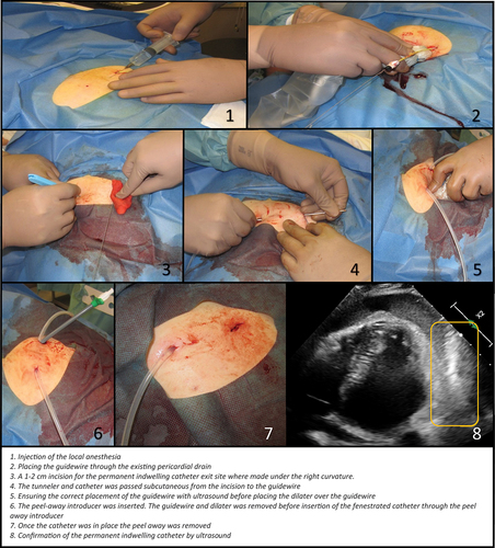 Figure 1. Pictures showing how the placement of a permanent indwelling catheter in the pericardial sac was preformed.