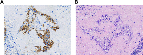 Figure 4 Pathological images of HCC patients. (A) Hematoxylin-eosin (HE) staining. (B) Hepatocyte IHC staining.