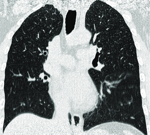 Figure 2.  A 53-year-old male with “risk for COPD” (smoking index 20 pack-years, FEV1/FVC%, 85.77%; %FEV1, 113.5%). (Figure 2a) Quantitative computed tomography (CT) in coronal plane shows normal lung as gray scale and small emphysema (threshold lower than −950HU) as blue. (Fig. 2b–Fig. 2c) coronal perfusion image acquired with DCE-MRI shows circumscribed but not wedge-shaped perfusion defects in the left upper field.