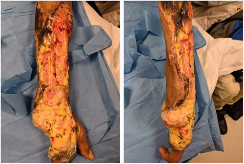 Figure 4. Meshed Integra placement.