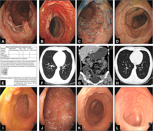 Figure 1 (A–D) Colonoscopy showed segmental intestinal disease; (E) pathology found inflammatory cell infiltration in intestinal mucosa, epithelioid granuloma in submucosa; (F) chest CT scan showed multiple patchy ground-glass shadows; (G) a total gastrointestinal CT angiography showed segmental leaping thickening in part of colon; (H) a repeat chest CT scan after systemic steroid therapy; (I–L) a repeat colonoscopy after three infliximab treatments.