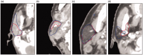 Figure 3. Four cases with low agreement between CC (in red) and DC (in blue) for the parotid gland. The cause for low agreement: (a) CC missed the anterior extension, (b) anatomical deviation because of cancerous lymph nodes pressing against the gland, (c) the DC incorrectly includes some voxels which result in a high HD, (d) anatomical deviation: exceptionally small parotid gland, for unknown reason.