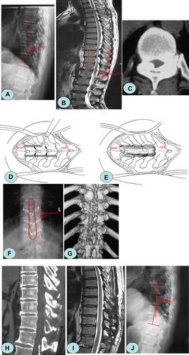 Figure 2 A 58-year-old female patient presented with a walking disability in both of the lower limbs for 17 months. (A) Preoperative X-ray showed that the thoracic vertebrae degenerated, and the local Cobb angle was 8.5°. (B, C) Preoperative magnetic resonance imaging and computed tomography showed ossification of the ligamentum flavum at the level of T9–12, and the spinal canal demonstrated severe stenosis. (D, E) A diagram of lamina osteotomy. (F, G) The decompression range and imaging findings after laminae replantation. (H, I) The ossification was thoroughly removed, and the spinal canal was unobstructed. (J) One year after surgery, the local Cobb angle increased to 11.4°.