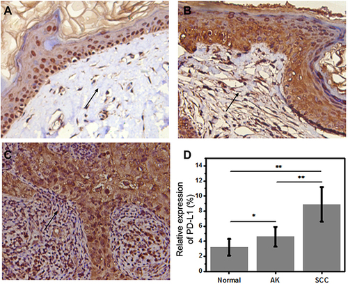 Figure 2 Immunohistochemical staining of expression of the PD-L1 molecule in different skin tissues (IHC). (A) PD-L1 negative expression in normal skin tissues. (B and C) PD-L1 positive expression in actinic keratosis and cSCC tissues. Magnification: 400×. (D) PD-L1 level as shown by a secondary scoring system. Arrows show the expression of PD-L1 in the tissue. (*P<0.05; **P<0.01).