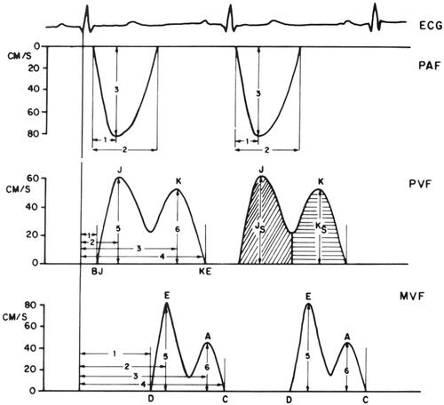 Figure 3. Intracardiac blood flow dynamics (taken from [Citation8] with permission from Wolters Kluwer Health, Inc). The electrocardiogram (ECG) is displayed on the top part of the image. Underneath, three different blood flow profiles are shown: pulmonary artery blood flow (PAF), pulmonary vein blood flow (PVF) and mitral valve blood flow (MVF).