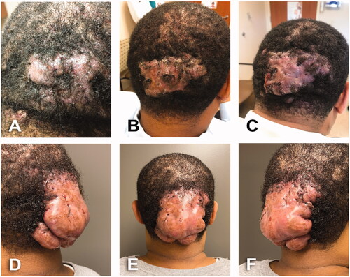 Figure 1. A 43-year-old male with 12 years history of scalp folliculitis that progressed into AKN. BMI 35 kg/m2. Fitzpatrick skin type 5. (A) Initial dermatology assessment. Dissecting scalp folliculitis; recommended rifampin (300 mg oral BID), clindamycin (300 mg oral BID), clindamycin lotion daily and triamcinolone cream. (B) AKN with firm thickened scarring on occipital scalp, areas of crusting, no active drains. Recommended doxycycline (100 mg oral BID), rifampin (300 mg oral BID), lidex solution and clindamycin lotion BID and intralesional injections of triamcinolone. (C) Progression of AKN lesion. Pink, firm thickened scarring plaques and purulent drainage. Patient continued follow-up in Dermatology clinic for 15 months and treated with Isotretinoin (40 mg oral daily) and additional intralesional injections of triamcinolone. (D–F) Preoperative assessment by Plastic Surgery. A 12 × 12 cm occipital infected fibrotic mass with multiple ingrowing hairs and points of purulent drainage.