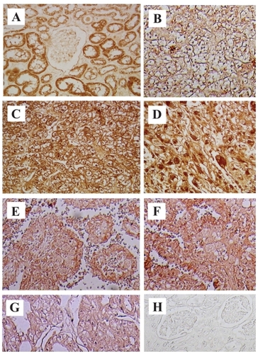 Figure 1 COX-2 immunostaining in RCC and normal kidney (NK) tissues. COX-2 was strongly expressed in all slides from cancer specimens, clear cell RCC -G1, -G2 and G3 (B, C and D) and other types of RCC tissues (E; papillary RCC G3, F; collecting duct carcinoma chromophobe RCC G2, G; chromophobe RCC G2). No expression of COX-2 was detected in NK tissue (A). Immunostaining with PBS was negative (H).