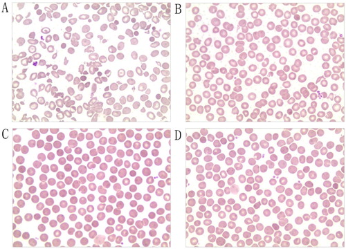 Figure 1. Morphology of peripheral blood erythrocytes (Wright–Giemsa, magnification, ×400). (A) Size of mature erythrocytes from proband varies. Some areas of lightly-stained, oval, spherical, and target-shaped central are expanded. (B) Mother; (C) Father; (D) Older brother.