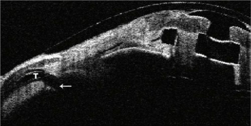 Figure 2 Anterior segment OCT demonstrating placement of a glaucoma drainage implant (arrow) in the pars plana.