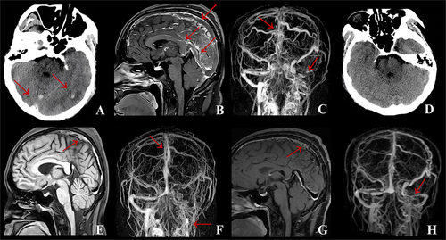 Figure 4 Case 4: (A) Brain CT on admission showed the thrombosis of straight sinus and left temporal-occipital lobe cerebral infarction with hemorrhage. (B) CE-MRBTI on admission revealed thrombosis occurred in the vein of Galen, straight sinus, superior sagittal sinus and torcular herophili. (C) CE-MRV on admission displayed that thrombosis was involved in the superior sagittal sinus, torcular herophili, left transverse sinus, sigmoid sinus and internal jugular vein. (D) After methylprednisolone therapy, brain CT demonstrated the straight sinus thrombosis and left temporaloccipital lobe cerebral infarction with hemorrhage disappeared. (E) After methylprednisolone therapy, MRBTI showed a reduction of thrombi in the vein of Galen, straight sinus, superior sagittal sinus and torcular herophili. (F) After methylprednisolone therapy, compared with (C), CE-MRV revealed a considerable decrease of thrombi in the superior sagittal sinus, torcular herophili, left transverse sinus, sigmoid sinus and internal jugular vein. (G) At 6-month follow-up, compared with (E), MRBTI showed thrombi in the vein of Galen, straight sinus and torcular herophili disappeared. (H) At 6-month follow-up, compared with (F), CE-MRV indicated thrombi of left transverse sinus and sigmoid sinus reduced.