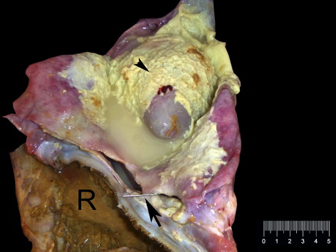 Figure 1. Fibrino-purulent exudate covering epicardium and exudate accumulation in the pericardial sac, and the needle (arrow) between reticulum (R) and the base of pericardial sac.