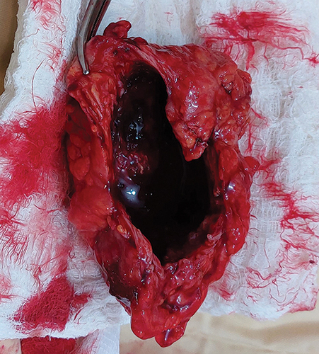 Figure 6 Resected surgical specimen with large cavity after surgical gauze removed.