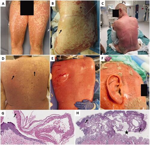 Figure 1. Two patient cases with TEN following ICI. (A) Pt. 1 at day 1 after admission to the BU. (B) Pt. 1 at day 10. (C) Pt. 1 at day 18. (D) Pt. 2 before admission to the BU. Generalized polymorphic eruption with dark red skin and positive Nikolsky’s sign (arrows). (E) Pt. 2 at day 4. Total epidermiolysis on the back. (F) Pt. 2 at day 8. (G) Skin biopsy from Pt. 1 showing intact stratum corneum, while full thickness epidermal necrosis is seen (arrow). Numerous necrotic keratinocytes at all levels of the epithelium is obvious. (H) Skin biopsy from Pt. 2 showing less apoptotic keratinocytes scattered through the epithelium (arrow). Subepidermal bulla formation can be seen (star), with infiltrate of inflammatory cells.
