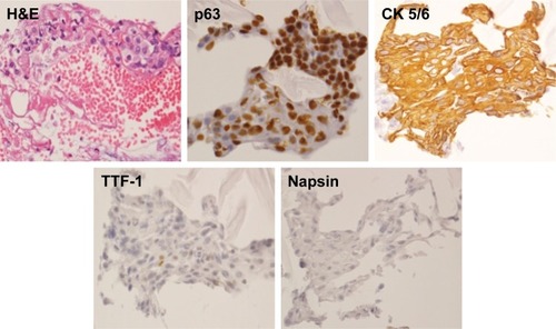 Figure 3 Images of bronchoscopic specimens stained for H&E and the indicated markers.