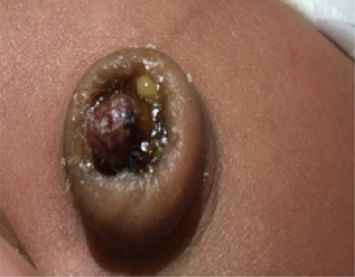 Figure 2 Infected umbilical granuloma with pussy discharge, but no erythema of the surrounding skin.