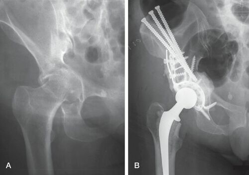 51 year old woman with primary tumor of sigma carcinoma with bone, lung, and liver metastasis. Harrington classification 2 (A). The modified Harrington’s procedure for periacetabular metastases (B). 3 cannulated screws are directed to the roof of the acetabulum and the periacetabular defect is supported by a restoration reinforcement ring. A cemented acetabular cup is implanted. The bone cement is used to augment the bone defects, reinforcement ring, and antegrade inserted screws.