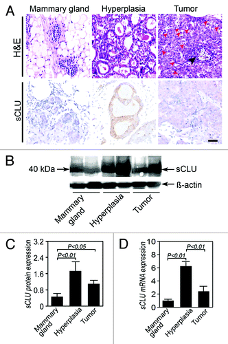 Figure 4. sCLU expression during TA2 spontaneous breast cancer progression. (A) H&E staining shows the morphology of a normal mammary gland, hyperplastic mammary glands, and breast cancer cells. Compared with the normal mammary gland, the number of cells and cell layers increase in the hyperplastic gland, and the cell and nucleus sizes also increase. IHC shows that the positive signal is localized in the cytoplasm, indicating that the protein is sCLU and not nCLU. A strong sCLU expression is detected in the mammary hyperplasia, whereas several mammary gland endothelial cells express sCLU. The sCLU expression in tumor cells is moderate. Ruler is 100 μm. (B) Western blot for clusterin (M-18). The expression of the 40 kDa sCLU is highest in the hyperplastic mammary epithelium, whereas the mammary epithelium of normal TA2 mice shows the lowest pre-sCLU expression. (C) Quantification of sCLU protein expression in the three groups (n = 4). The sCLU protein level in the normal mammary epithelium is significantly lower than that in the other groups. (D) sCLU mRNA expression among the three groups (n = 6). The hyperplastic mammary epithelium from TA2 mice with spontaneous breast cancer shows the highest sCLU mRNA expression among the three groups, whereas sCLU is the lowest in the mammary gland of normal TA2 mice. Spontaneous breast cancer expresses a middle level sCLU expression. Significant differences are found. The error bar means standard deviation (SD).