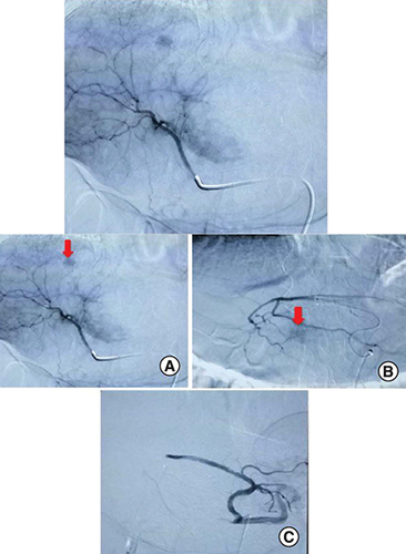 Figure 4. Hepatic arteriogram with selective catheterization of the right hepatic artery from the femoral artery.(A & B) A progressive blush of both lesions (red arrows) following the injection of contrast media. (C) Angiographic control showing total disappearance of the tumoral blush.