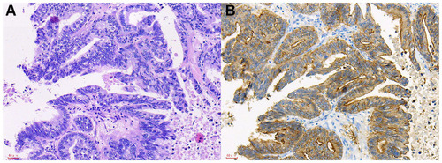 Figure 2 The HE staining and IHC images from gastric adenocarcinoma OM patients.