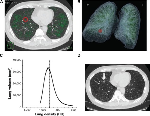Figure 5 Chest CT scans before and after the appearance of a malignant lesion and the histogram of lung density distribution in a patient who had emphysema, but no interstitial abnormalities.Notes: (A) A transverse CT image at enrollment with superimposed LAA (<−95 HU: green). The red circle indicates the precancerous sphere. (B) The location of the sphere is visualized on 3D CT image (red circle). (C) Histogram of CT density distribution of the entire lungs. The area under the curve of the histogram is total lung volume. The median of whole lung density is indicated as a dotted line. The solid line indicates the local lung density of precancerous sphere. (D) A transverse CT image when a suspicious lesion (arrow) was detected at the same level of A.Abbreviations: CT, computed tomography; LAA, low attenuation area; HU, Hounsfield unit; 3D, three dimensional; A, anterior; R, right; L, left; P, posterior.