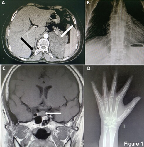 Figure 1. CT and MRI test for patient. (A) Enhanced CT of the patient’s abdomen, right adrenal hyperplasia by the black arrow, left adrenal hyperplasia by the white arrow; (B) Rabat; (C) Patient’s head MRI and hyperplastic pituitary by the white arrow. (D) Left-hand flat piece and bone age