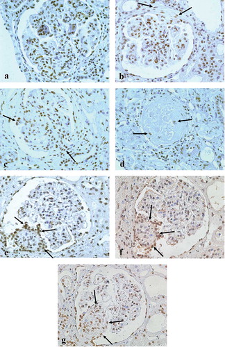 Figure 4.  Sp1 immunopositivity in various pathologic lesions of diseased glomeruli: a) hyperplastic lesions (proliferative lupus nephritis, WHO class IV), b) a cellular crescent (arrows) (Wegener granulomatosis), (c) a microadhesion (arrows) (proliferative lupus nephritis, WHO class IV), d) a globally sclerosed glomerulus, and e) a segmental sclerotic lesion (arrows) (IgA nephropathy); (e–g) serial sections of a glomerulus from a patient with IgA nephropathy exhibiting prominent Sp1 (4e), pSmad2/3 (4f) and p300 expression (4g) in cells overlying a sclerotic segment. (Figures 4e and 4g are reproduced from Kassimatis et al. [2006].Citation[17]) Original magnification ×400.