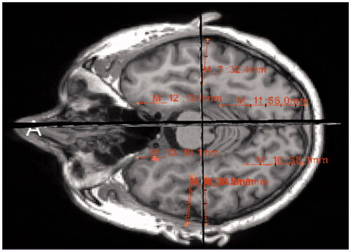 Figure 7. Measuring distance of hippocampus using ruler tool in the Slicer software.