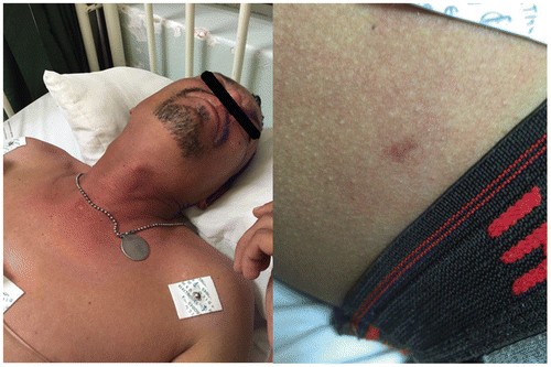 Figure 3: Flushing and bite site with surrounding erythema.