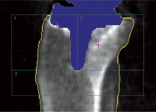 Figure 5. LA densitometry analysis of a right tibia (cruxiate stem implant) with software-automated metal removal (blue) and bone-edge detection (yellow line), and manual positioning of the 3-ROI BMD analysis template. The bone of the fibula was included in the analysis.